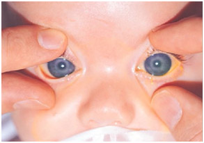 Can children develop Glaucoma?