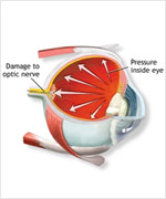 How Glaucoma affects Sight?