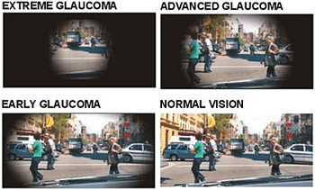 What are the symptoms of Glaucoma?