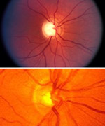 What is Glaucoma?