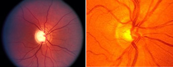 What is Glaucoma?