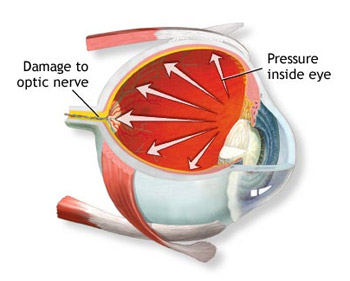 Why does Glaucoma occur?