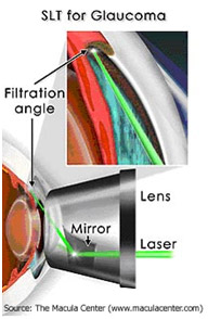 SLT for Glaucoma